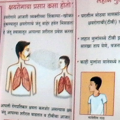 Poster Exhibition on Tuberculosis (TB)